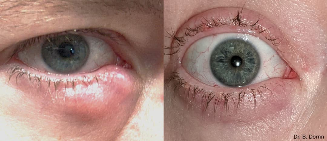 Forma-I RF Treatment Before & After