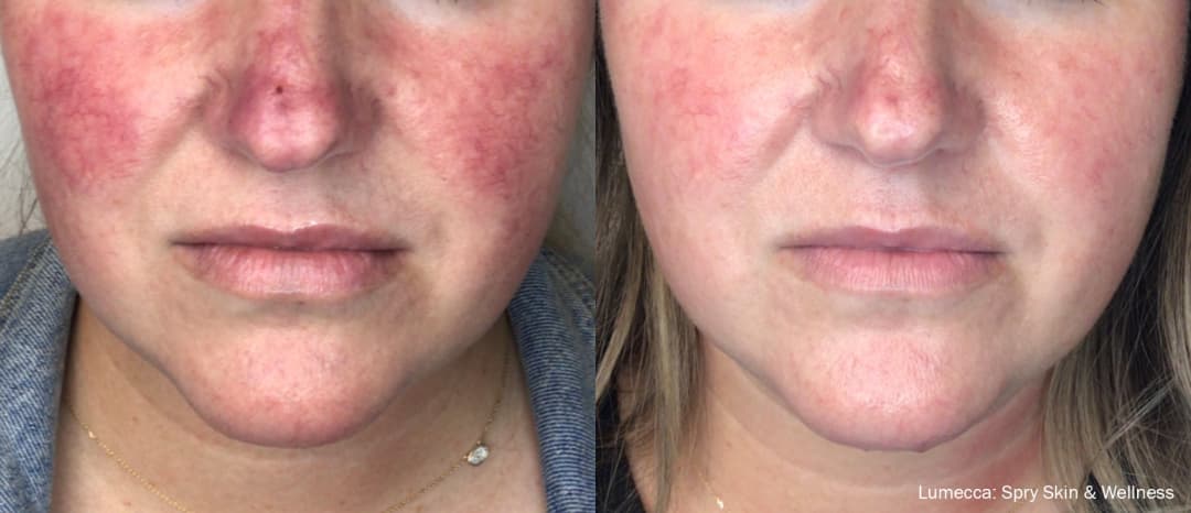 Lumecca Before and After Treatment