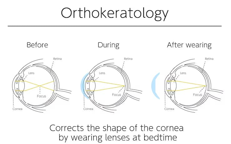 Ortho-K