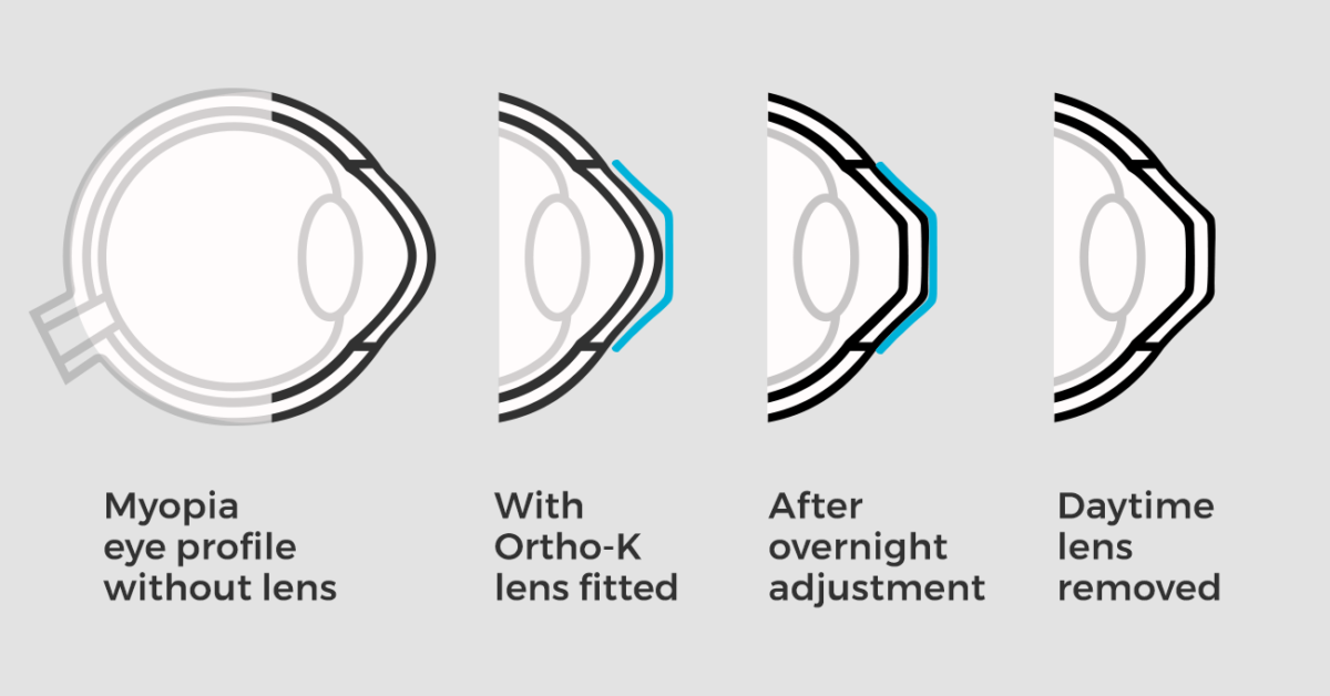 myopia correction with ortho k